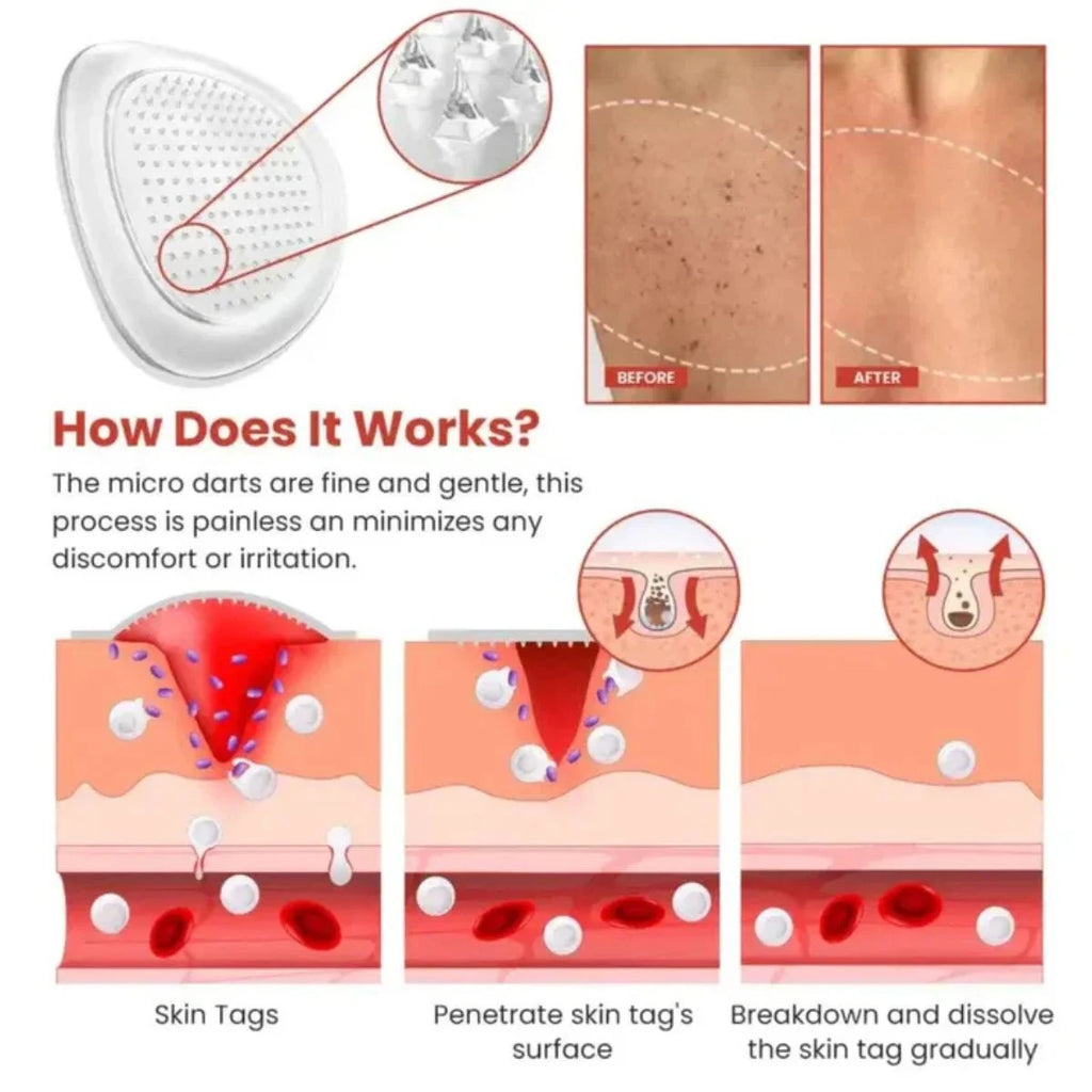 DermaSmooth Skin Tag Remover Patch |  Fast, Safe & Painless Skin Tag & Mole Removal | Nano-Microneedle Technology | 72 Patches